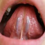 基礎の舌診断法 舌下脈絡
